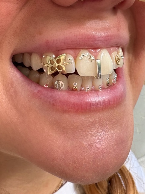Close-up of mixed tooth jewelry: a gold butterfly, a gold star, a skull gem, and scattered crystal tooth gems across upper and lower teeth