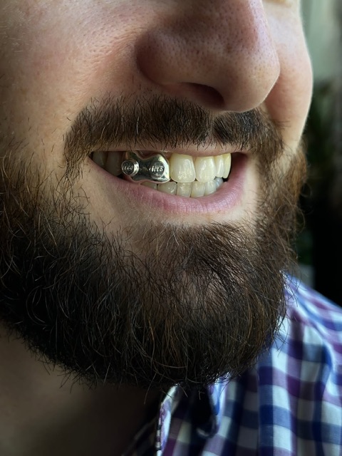 Bearded client showing a single engraved white-gold cap on an upper tooth