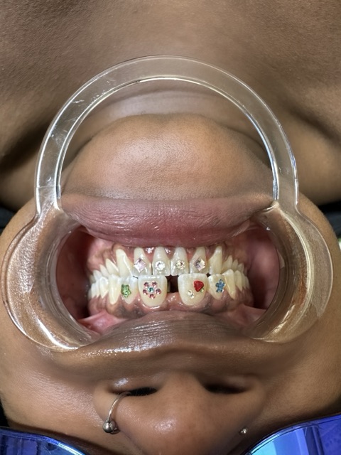 A full set of colourful tooth gems, including flowers and a red heart, across the upper teeth, with a clear dental retractor holding the lips clear