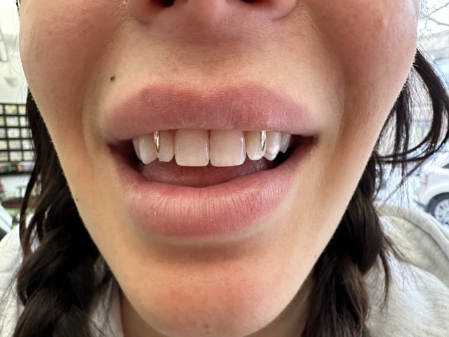 Close-up of a subtle pair of crystal tooth gems on the upper front teeth