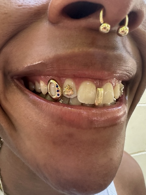 Gold tooth caps mixed with crystal tooth gems across the upper teeth, worn with double gold nostril rings