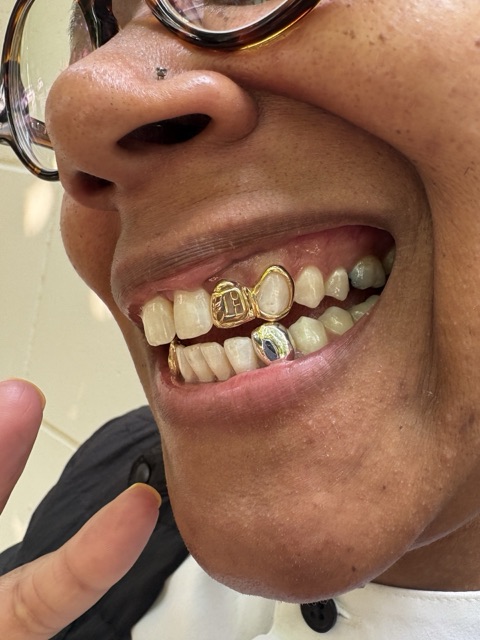 Mixed gold and white-gold tooth caps, including an engraved initial cap and an open gold frame